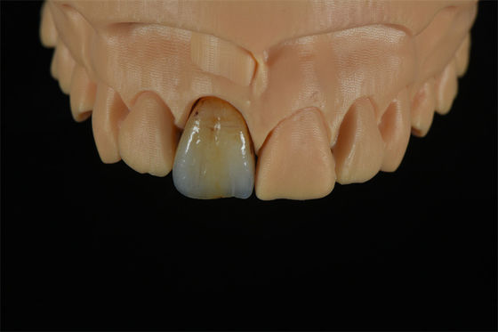 calidad  Affordable Zirconia Crowns with Custom Color Staining - China Dental Lab fábrica